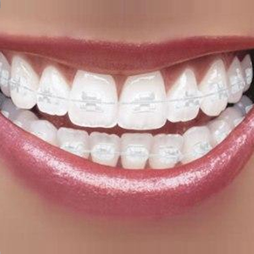 Braces for Cosmetic Correction