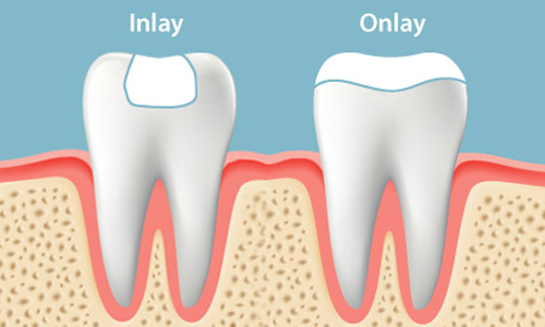 Inlays and Onlays Carrollton Advanced Family Dentistry